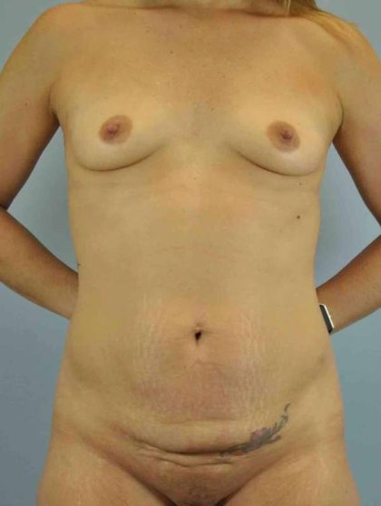 Breast Augmentation Before & After Patient #12070