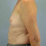 Breast Augmentation Before & After Patient #12082