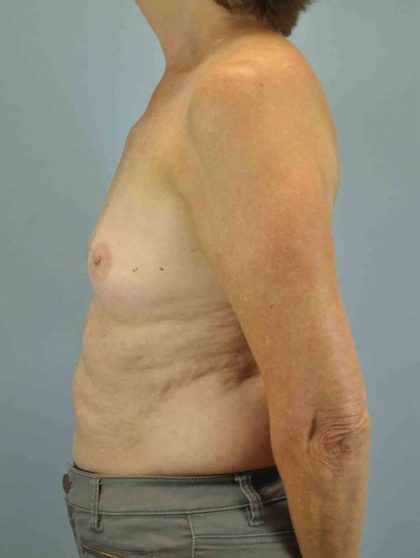 Breast Augmentation Before & After Patient #12082