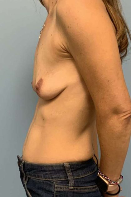 Breast Augmentation Before & After Patient #12108