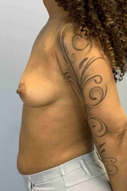 Breast Augmentation Before & After Patient #12113