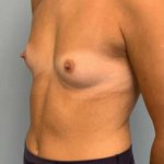Breast Augmentation Before & After Patient #12127
