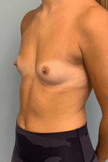 Breast Augmentation Before & After Patient #12127