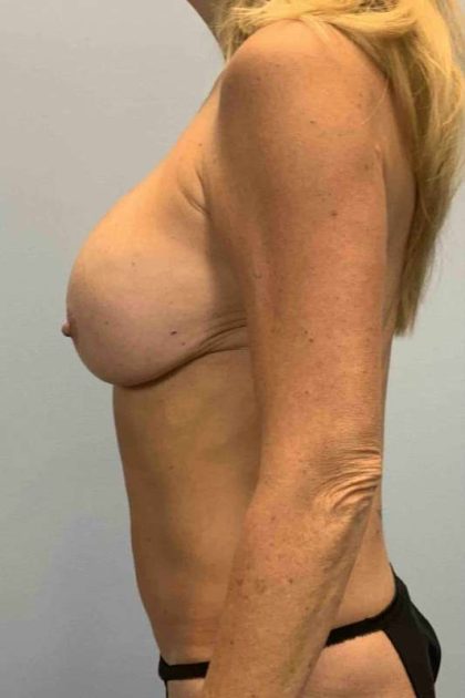Breast Augmentation Before & After Patient #12136