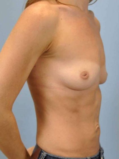 Breast Augmentation Before & After Patient #12143