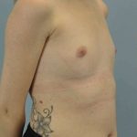 Breast Augmentation Before & After Patient #12157