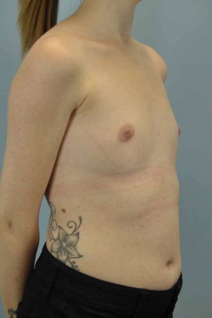 Breast Augmentation Before & After Patient #12157