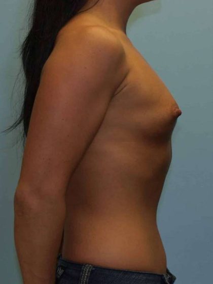 Breast Augmentation Before & After Patient #12164
