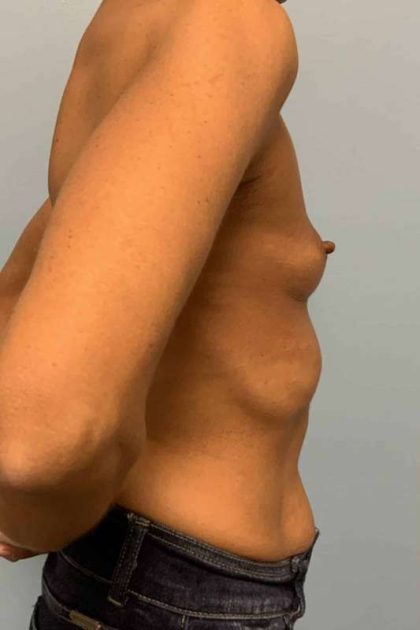 Breast Augmentation Before & After Patient #12171