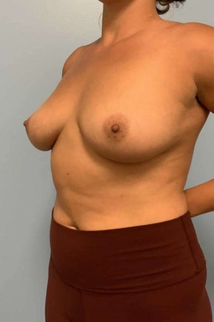 Breast Augmentation Before & After Patient #12178