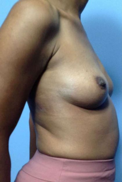 Breast Augmentation Before & After Patient #12199