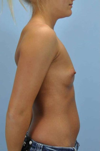 Breast Augmentation Before & After Patient #12206