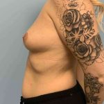 Breast Augmentation Before & After Patient #12227