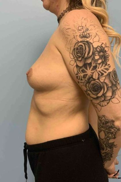 Breast Augmentation Before & After Patient #12227