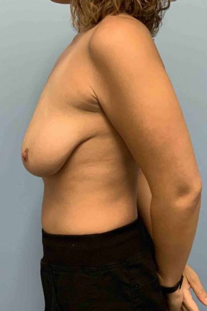 Breast Augmentation Before & After Patient #12234