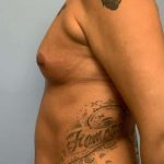 Breast Augmentation Before & After Patient #12253