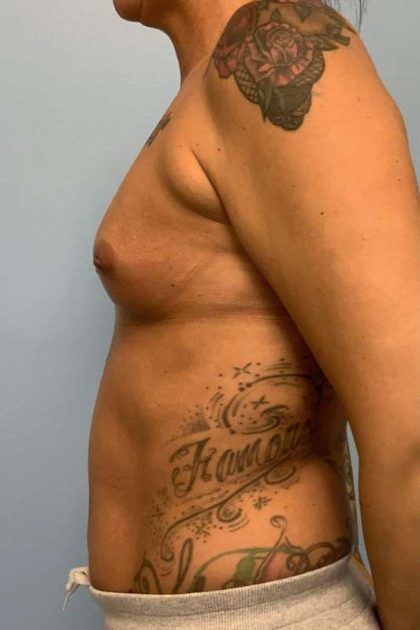 Breast Augmentation Before & After Patient #12253