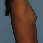 Breast Augmentation Before & After Patient #12260