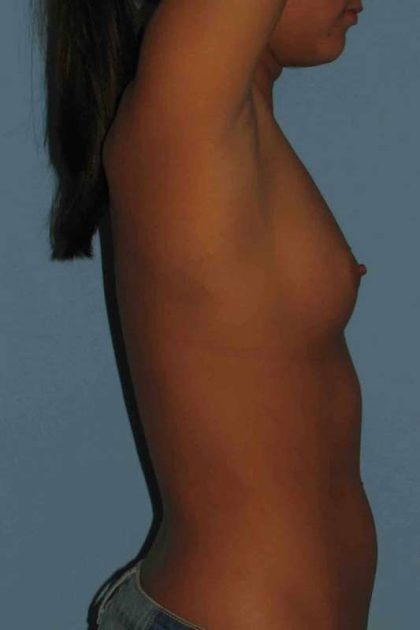 Breast Augmentation Before & After Patient #12260
