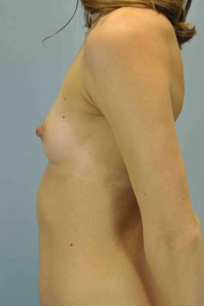 Breast Augmentation Before & After Patient #12267