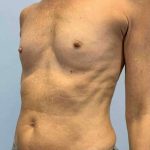 Breast Augmentation Before & After Patient #12281