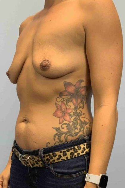 Breast Augmentation Before & After Patient #12288