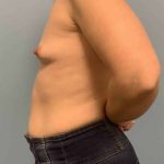 Breast Augmentation Before & After Patient #12295