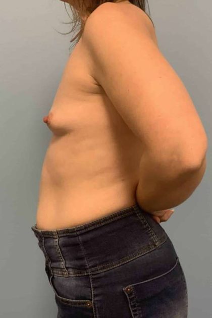 Breast Augmentation Before & After Patient #12295