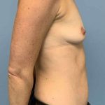 Breast Augmentation Before & After Patient #12302
