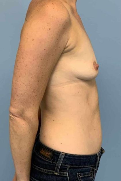 Breast Augmentation Before & After Patient #12302