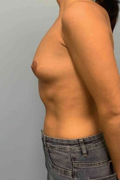 Breast Augmentation Before & After Patient #12330