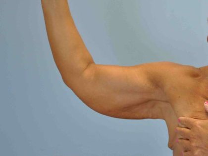 Brachioplasty Before & After Patient #12335
