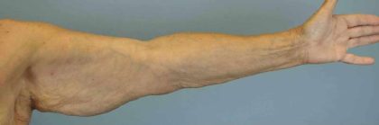 Brachioplasty Before & After Patient #12348