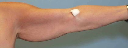 Brachioplasty Before & After Patient #12353