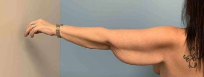 Brachioplasty Before & After Patient #12362