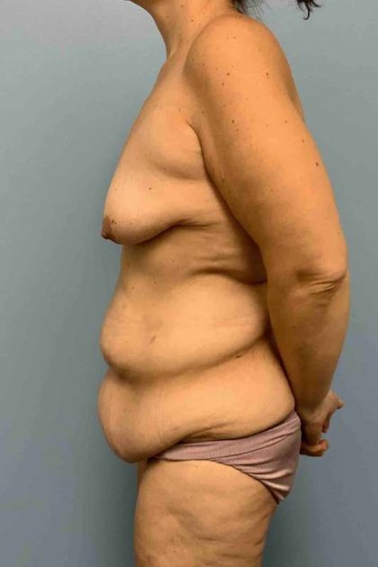 Belt Lipectomy Before & After Patient #12378