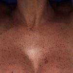 BBL Forever Young Before & After Patient #12381