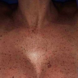 BBL Forever Young Before & After Patient #12381
