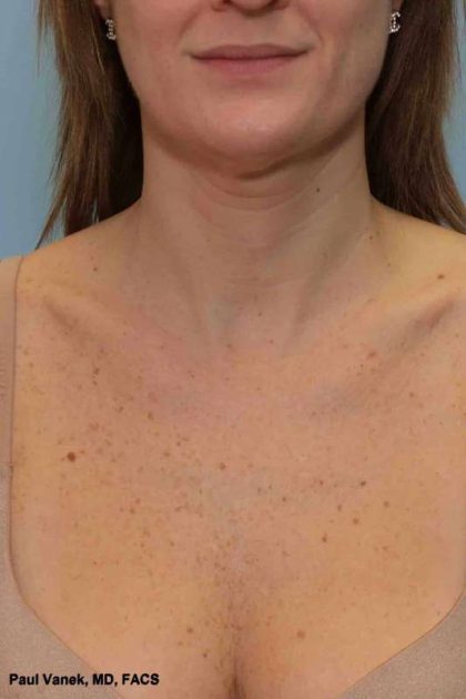 BBL Forever Young Before & After Patient #12389