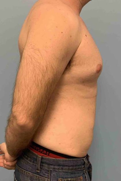 VASER Liposelection Before & After Patient #10434