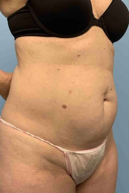 VASER Liposelection Before & After Patient #10446