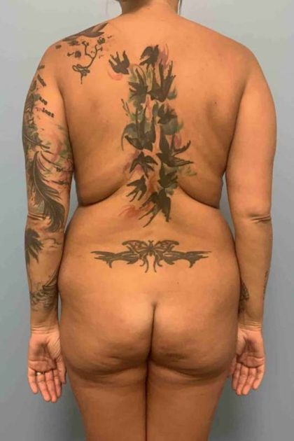VASER Liposelection Before & After Patient #10479