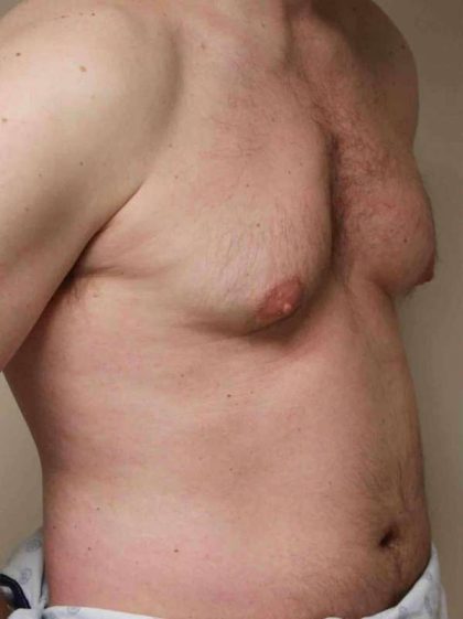 VASER Liposelection Before & After Patient #10486