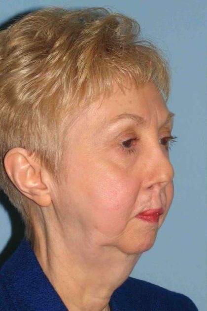 VASER Liposelection Before & After Patient #10500