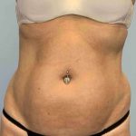 VASER Liposelection Before & After Patient #10407