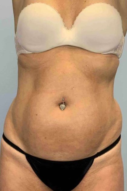 VASER Liposelection Before & After Patient #10407