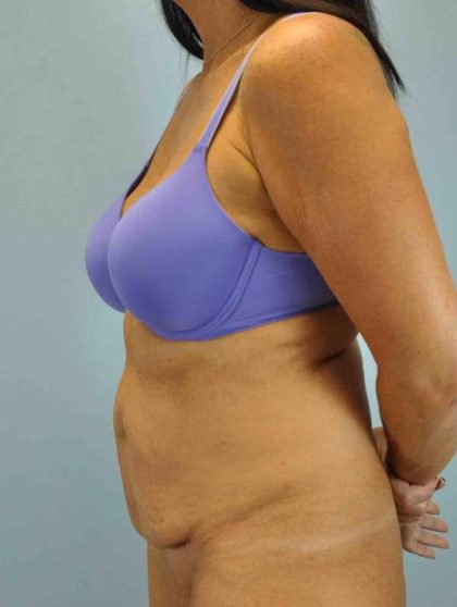 VASER Liposelection Before & After Patient #10511
