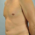 VASER Liposelection Before & After Patient #10527