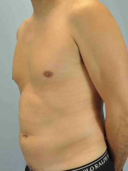 VASER Liposelection Before & After Patient #10527