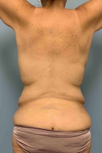 VASER Liposelection Before & After Patient #10561